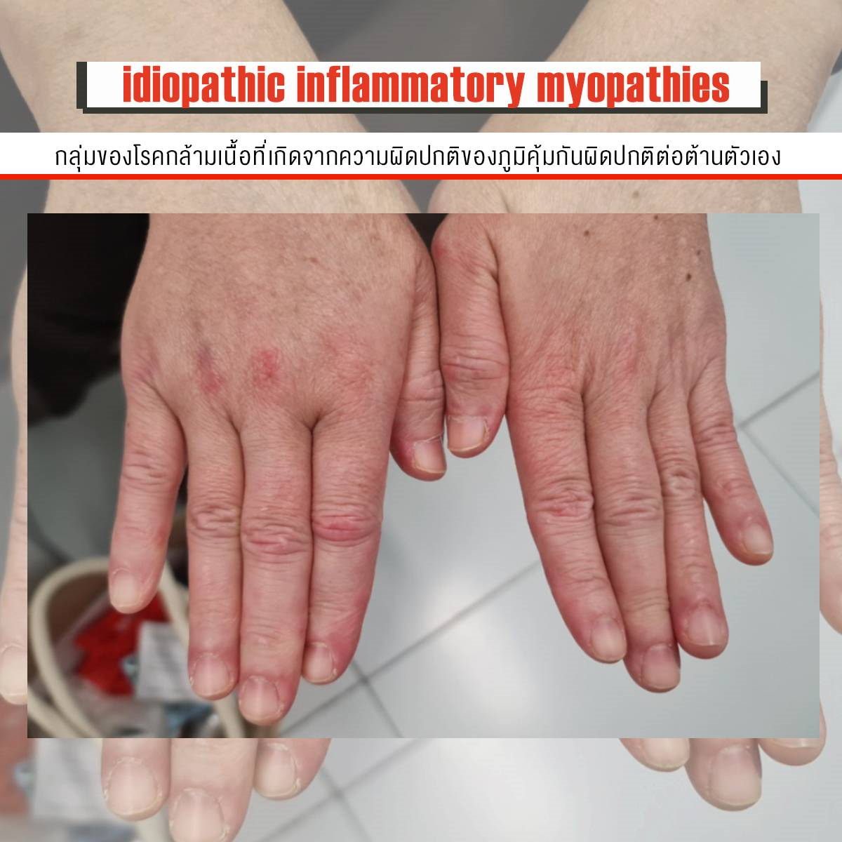 โรงพยาบาลราชวิถี เผย idiopathic inflammatory myopathies (IIMs) กลุ่มของโรคกล้ามเนื้อที่เกิดจากความผิดปกติของภูมิคุ้มกันผิดปกติต่อต้านตัวเอง